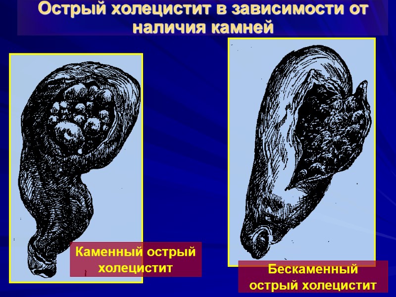 Острый холецистит в зависимости от наличия камней Каменный острый  холецистит Бескаменный острый холецистит